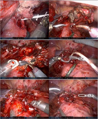 Robotic hepatectomy and cholecystectomy in the management of intraductal papillary mucinous neoplasm of the biliary tract: A case report and literature review