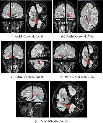 A new surgical path planning framework for neurosurgery