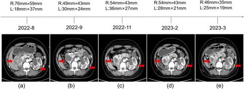 Comprehensive treatment of von Hippel-Lindau disease: A case report