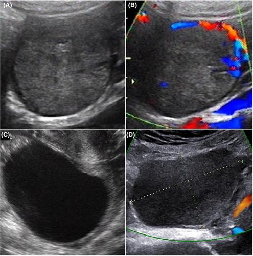 Imaging features, clinical characteristics and neonatal outcomes of pregnancy luteoma: A case series and literature review