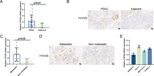 miR-1180 Targets FXYD5 to Regulate Pancreatic Cancer Cells Migration and Invasion.