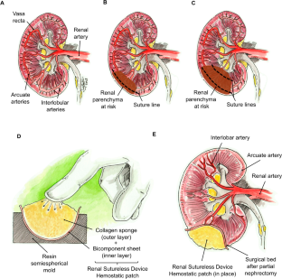 Reconstruction Techniques After Partial Nephrectomy: Classic vs. Sutureless Approach—A Narrative Review