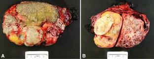 Giant bilateral prepubertal-type teratomas in a postpubertal patient: An illustrative case and review of the literature.