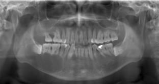 Dentigerous cysts suspected the other odontogenic lesions on panoramic radiography and CT.