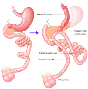 Single Anastomosis Duodenoileostomy with Sleeve: A Comprehensive Review of Anatomy, Surgical Technique, and Outcomes.