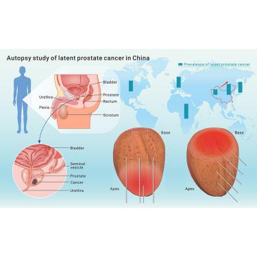 Updated prevalence of latent prostate cancer in Chinese population and comparison of biopsy results: An autopsy-based study