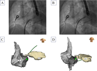 Inadvertent novel access to the left ventricle through the membranous septum.