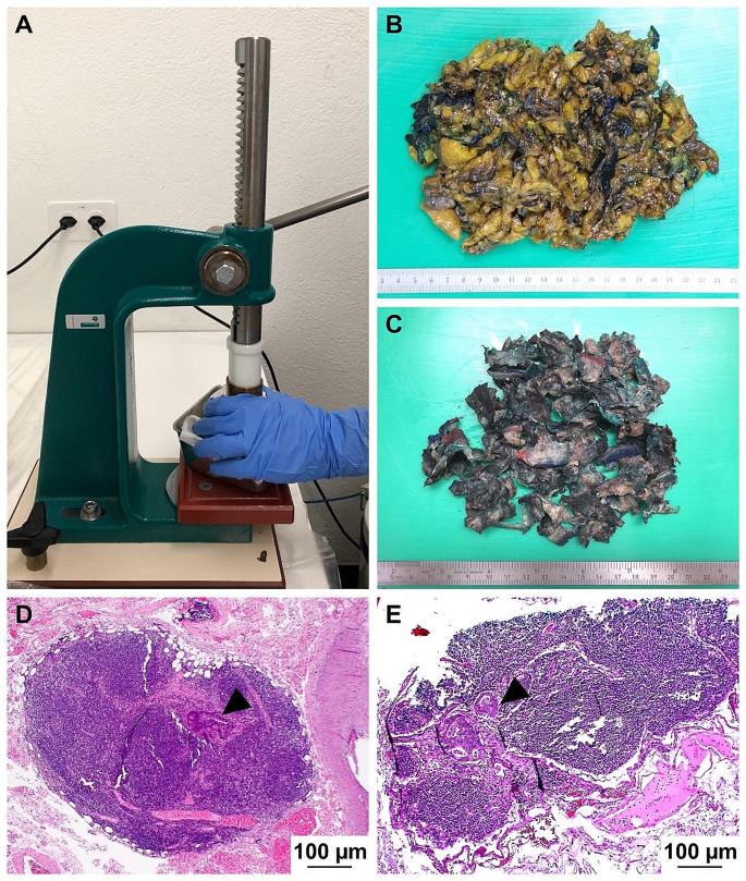 Acetone compression improves lymph node yield and metastasis detection in colorectal cancer.