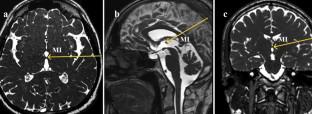 Massa intermedia in adults: incidence, dimension, location and clinical importance