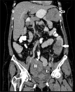 A Case Report of Bilateral Endometrioid-Type Ovarian Carcinoma with Synchronous Dual Metastasis to the Colon