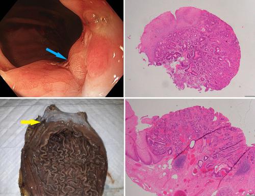 Li Fraumeni Syndrome predisposes to gastro-esophageal junction tumours.