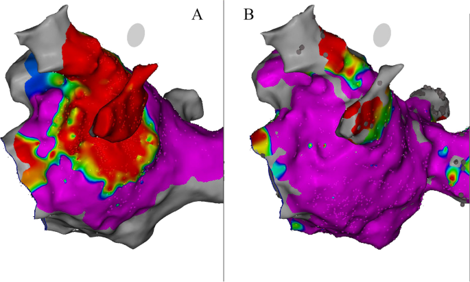 A proposed index of myocardial staining for vein of Marshall ethanol infusion: an Italian single-center experience.