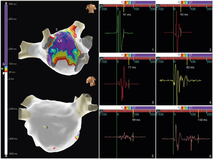 Ablation of persistent atrial fibrillation based on atrial electrogram duration map: methodology and clinical outcomes from the AEDUM pilot study.