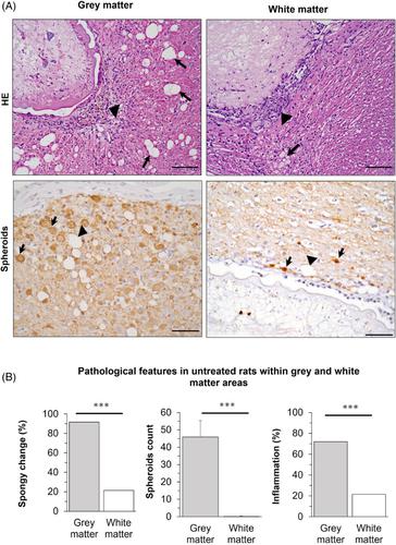 Understanding the pathogenic mechanisms and therapeutic effects in neurocysticercosis