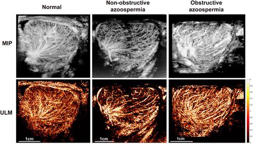 Super-resolution ultrasound localization microscopy for the non-invasive imaging of human testicular microcirculation and its differential diagnosis role in male infertility