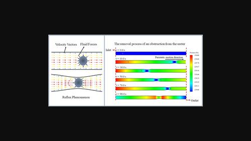 Numerical analysis of an obstacle motion in the human ureter using the dynamic mesh approach