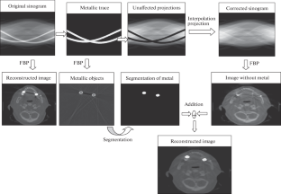 X-ray CT Metal Artifact Reduction Using Segmentation and TV Regularisation