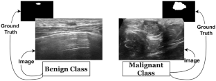 An Automated Decision Support System to Analyze Malignancy Patterns of Breast Masses Employing Medically Relevant Features of Ultrasound Images