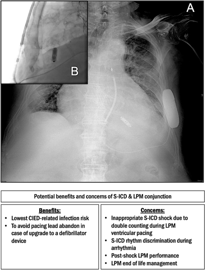 Co-presence of subcutaneous implantable cardioverter-defibrillator and leadless pacemaker in high-risk infection patients: are we out of the woods?