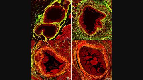 Label-free assessment of pathological changes in pancreatic intraepithelial neoplasia by biomedical multiphoton microscopy