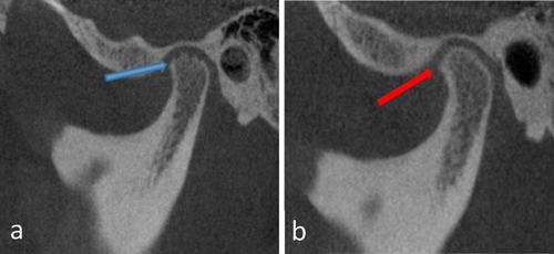 Diagnostic accuracy of MRI-CBCT fused images in assessment of clinically diagnosed internal derangement of the temporomandibular joint.