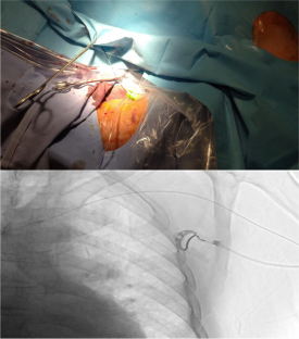 A wire to guide: a complementary method for facilitating access during device lead implantation using a guidewire inserted through a peripheral vein.