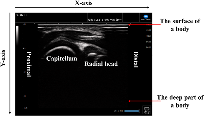 Deep learning-based osteochondritis dissecans detection in ultrasound images with humeral capitellum localization.