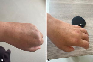 Intramuscular botulinum toxin-A in complex regional pain syndrome resistant to standard treatment: a case report.