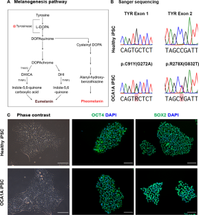 Generation and characterization of retinal pigment epithelium from patient iPSC line to model oculocutaneous albinism (OCA)1A disease