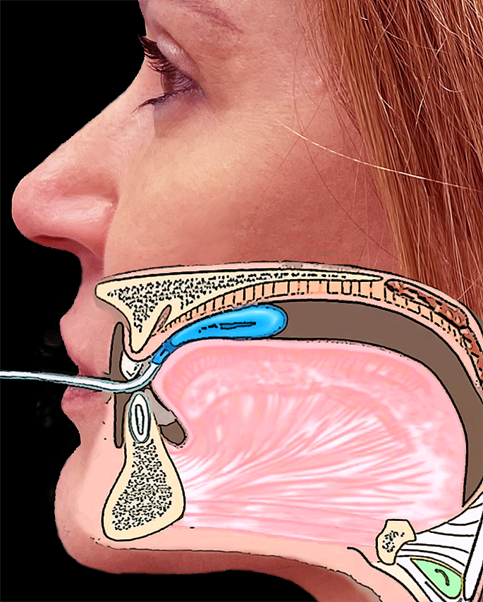 Maximum Anterior Tongue Strength and Maximum Lip Strength in Healthy Spanish Adults: A Proposal of Reference Values.