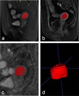 Predicting Risk Stratification in Early-Stage Endometrial Carcinoma: Significance of Multiparametric MRI Radiomics Model