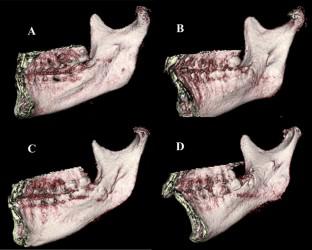 Determining the safety margin of mandibular lingula in sagittal split ramus osteotomy