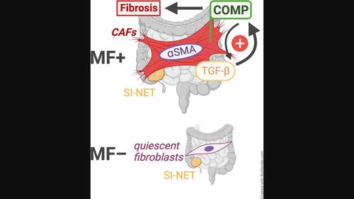 Mesenteric fibrosis in patients with small intestinal neuroendocrine tumors is associated with enrichment of alpha-smooth muscle actin-positive fibrosis and COMP-expressing stromal cells