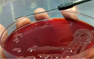 Genotypic characterization of hypervirulent Klebsiella pneumoniae (hvKp) in a tertiary care Indian hospital.