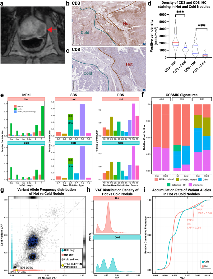 Divergent immune microenvironments in two tumor nodules from a patient with mismatch repair-deficient prostate cancer