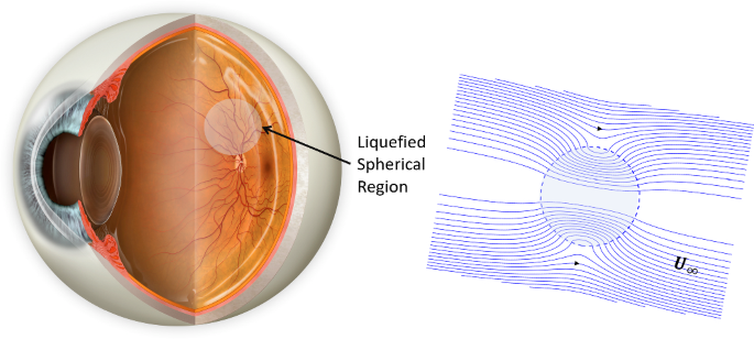 Flow Characterization in a Partially Liquefied Vitreous Humor