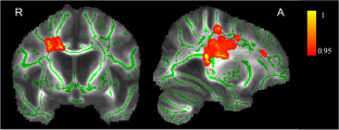 More organized white matter is associated with positivity bias in older adults.