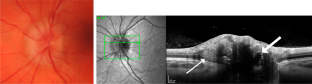 Advantages and Pitfalls of the Use of Optical Coherence Tomography for Papilledema.