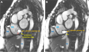 Real-time cardiovascular magnetic resonance-guided catheter ablation for cavotricuspid isthmus with complex anatomy.