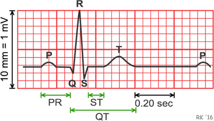 Electrocardiogram prediction based on variational mode decomposition and a convolutional gated recurrent unit