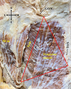 The triangular area between the greater, lesser, and third occipital nerves and its possible clinical significance