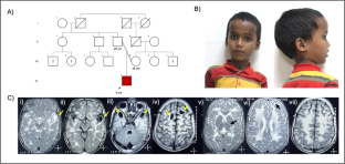 Intragenic homozygous duplication in HEPACAM is associated with megalencephalic leukoencephalopathy with subcortical cysts type 2A.