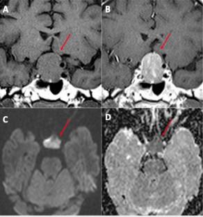 Diffusion-weighted imaging does not seem to be a predictor of consistency in pituitary adenomas.