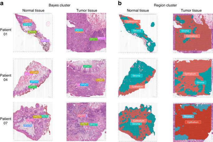 Spatial transcriptomics reveals that metabolic characteristics define the tumor immunosuppression microenvironment via iCAF transformation in oral squamous cell carcinoma.