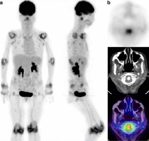 Role of PET/CT in diagnosing and monitoring disease activity in rheumatoid arthritis: a review.