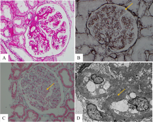 Rituximab alleviates pediatric systemic lupus erythematosus associated refractory immune thrombocytopenia: a case-based review.