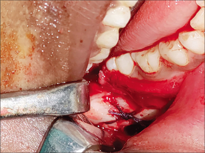 A Novel Method to Fix Paediatric Mandibular Fracture using 2-0 Polyglactin Suture: A Technical Note.