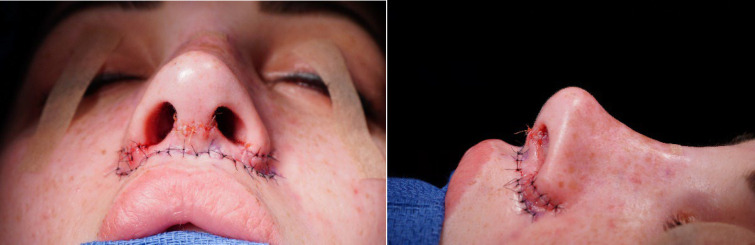 The Safety and Outcomes of Simultaneous Open Rhinoplasty, Alar Reduction, and Upper Lip-Lift through One Surgery.