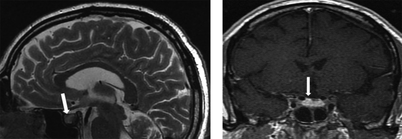 [Differential diagnosis and tactics of managing a patient with primary hypophysitis on the example of a clinical case].