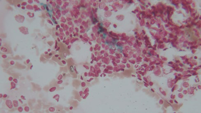 Evaluation of the Findings of Peripheral Blood Smear, Bone Marrow Aspiration and Biopsy, Iron Storage, and Immunophenotype in Patients with Chronic Lymphocytic Leukemia.